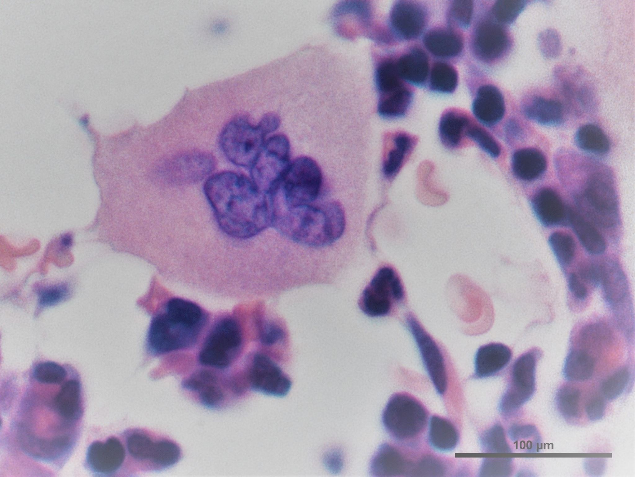 Megacariocito en la médula ósea. Hematoxilina-Eosina.